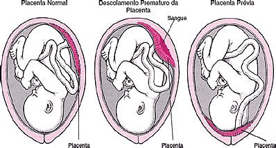 deslocamento de placenta
